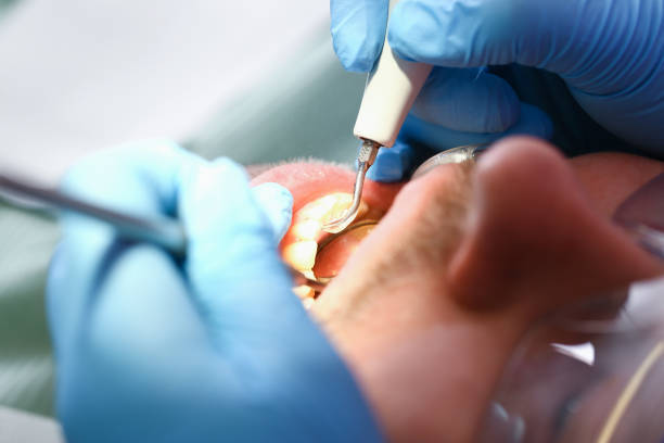 Best Emergency Dental Extractions in Windsor, VA